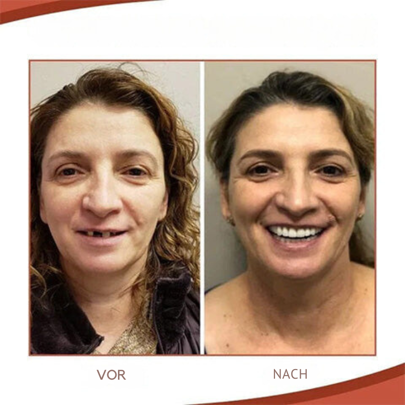 Thomasequestrian | Biocompatible Prosthesis Set for Natural Smile & Comfort